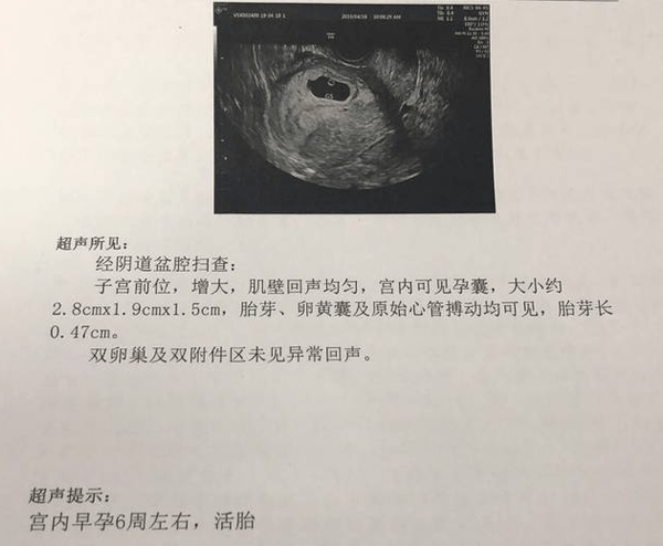 孕六周无胎心表示胎儿可能已经停育