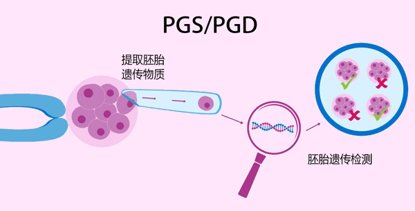 PGD能诊断单基因缺陷诱发的疾病