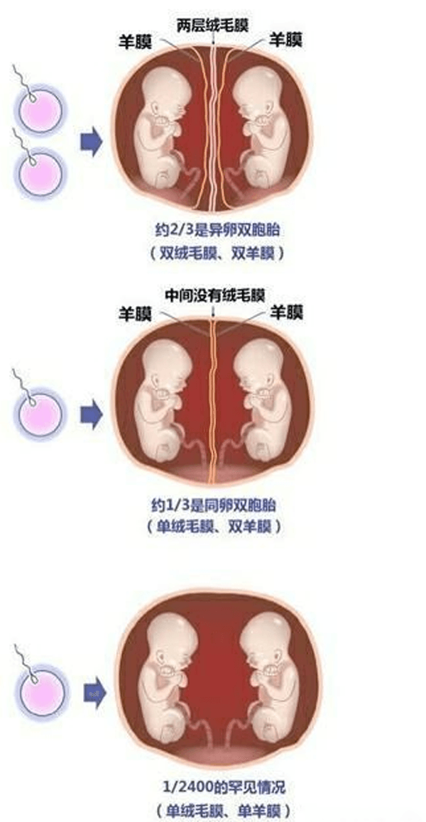 囊胚移植能有效避免多胎妊娠