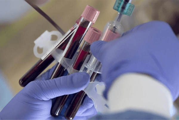抽血是性激素六项的常见检查方法