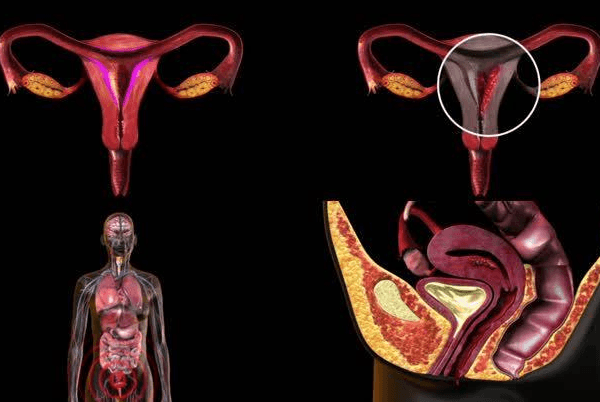 卵巢疾病是雌二醇偏低的原因之一
