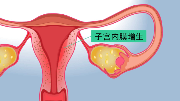 子宫内膜能通过达芙通来预防增生