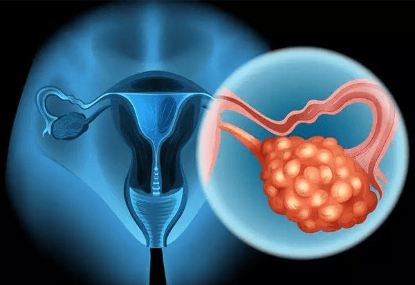 使用贺美奇可能会出现卵巢过度刺激