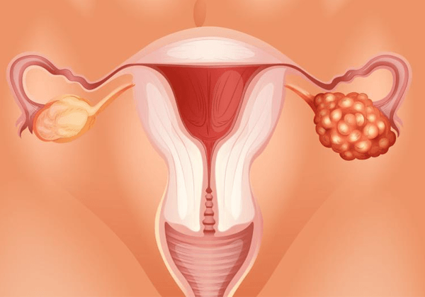 卵巢癌能通过巢倍滋进行预防