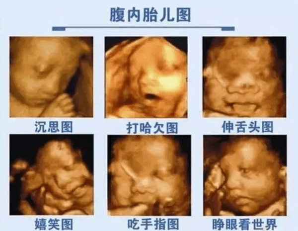四维彩超有判断胎儿是否正常的作用