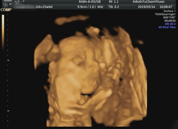 胎儿侧面图能看出胎儿脊柱是否正常