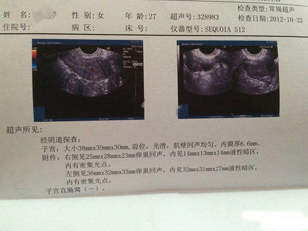 确诊巧囊检查的报告单