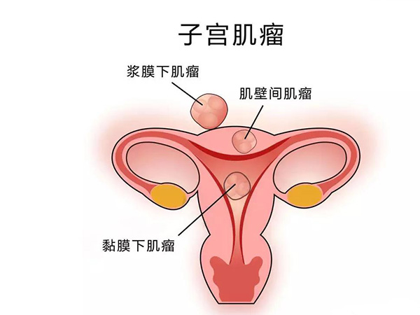 子宫肌瘤在女性群体中比较普遍