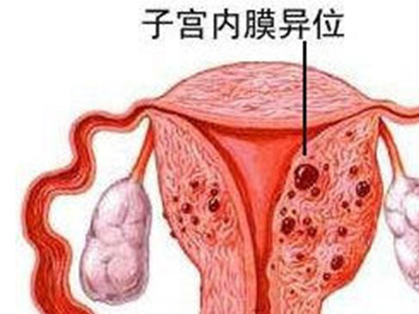 子宫内膜异位症比较常见