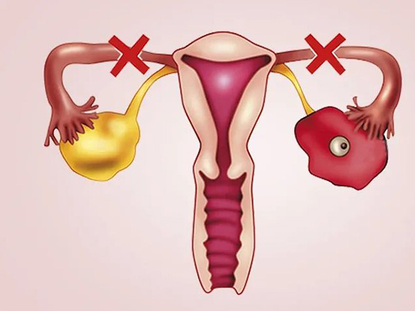 腹痛是输卵管堵塞的常见表现